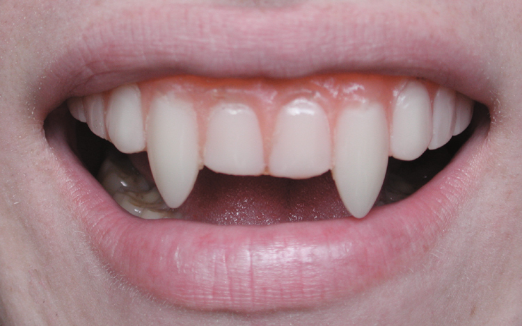 lindsay lohan vampire teeth. horrible vampire teeth,